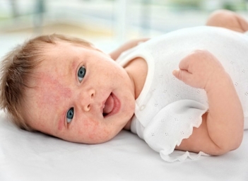 Hướng dẫn xử lý khi bé bị dị ứng sau khi ăn cháo hạt kê mẹ cần biết
